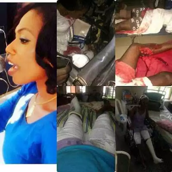 Nigerian artiste whose leg was crushed by Dangote truck cries out for justice